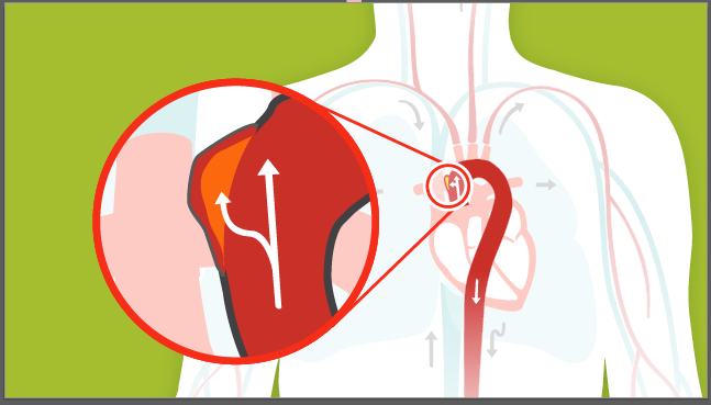 Aortic aneurysm image