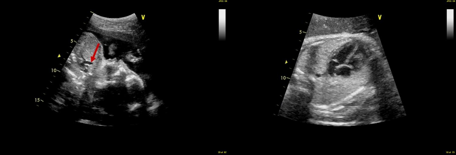 pe-img-fetalecho-internal