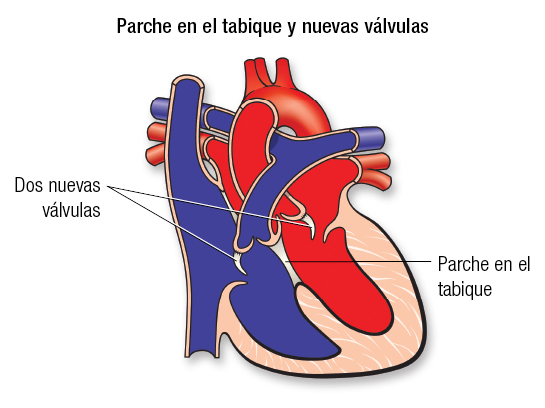 Reparación del canal AV Español