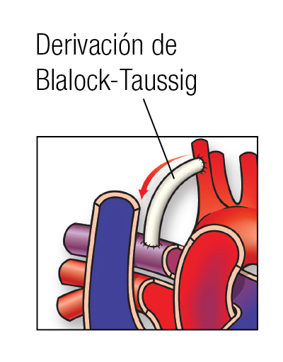 HLHS BT Shunt SP