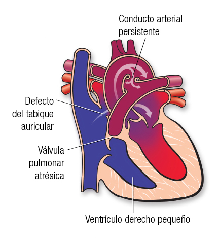 Pulmonary Atresia SP