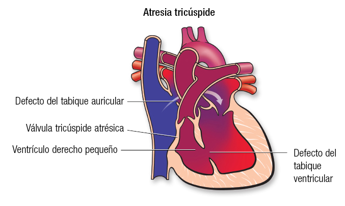 Atresia tricúspide Español