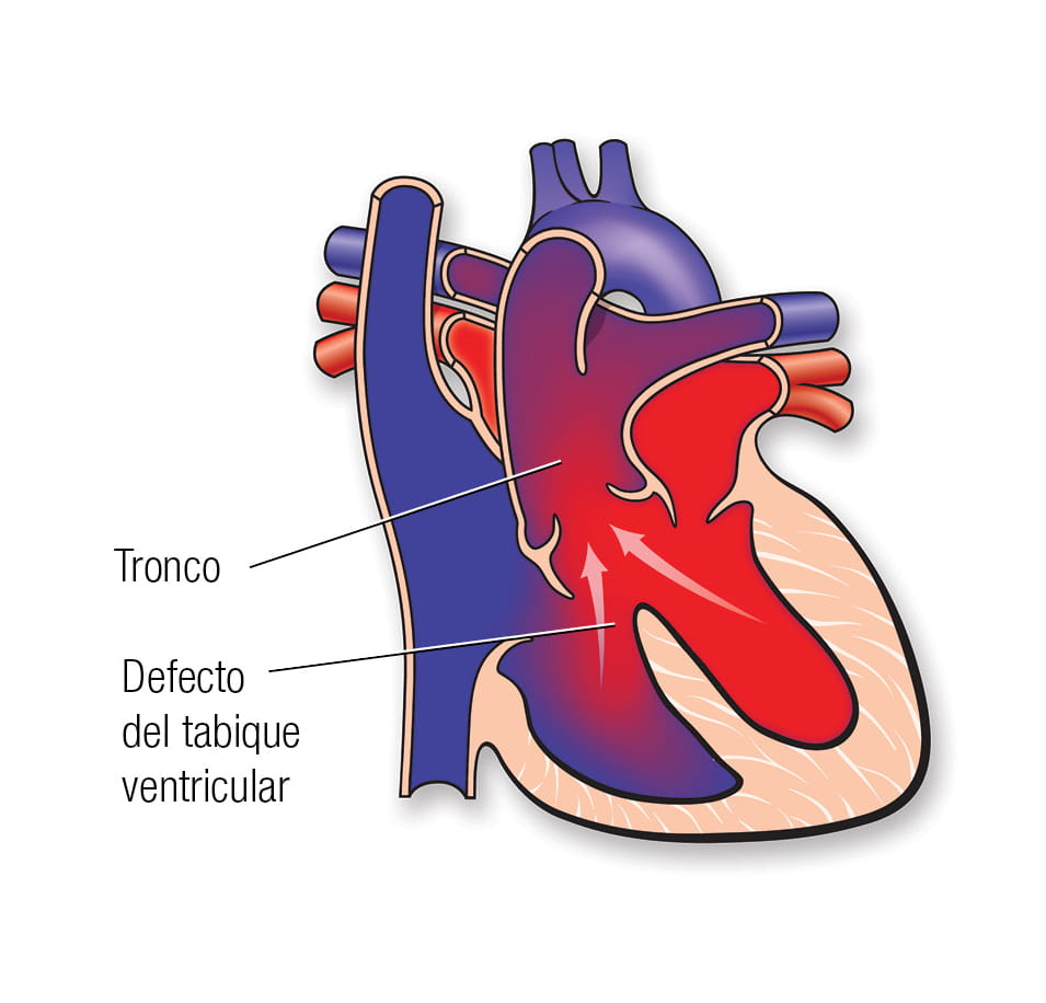 Truncus arteriosus in Spanish