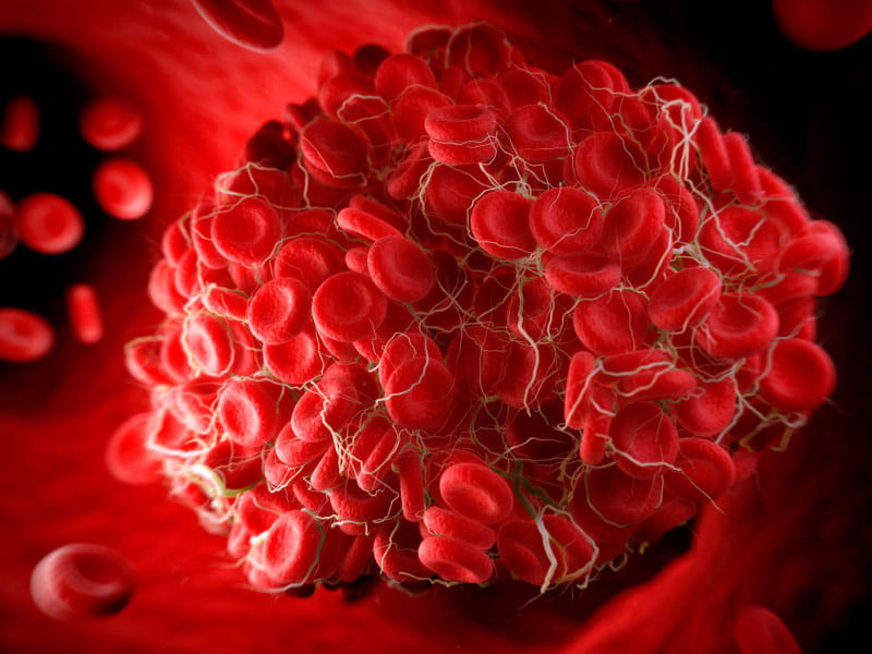 Blood Clot Risk Remains Elevated Nearly A Year After COVID 19 Go Red   0919CoronavirusBloodClots SC 