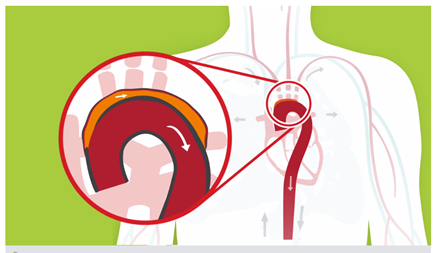 medical illustration of an aorta medical illustration of an aorta