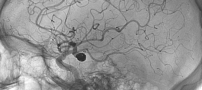 Stroke in brain image